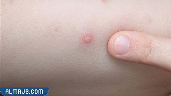 نصائح للوقاية من مرض جدري القرود