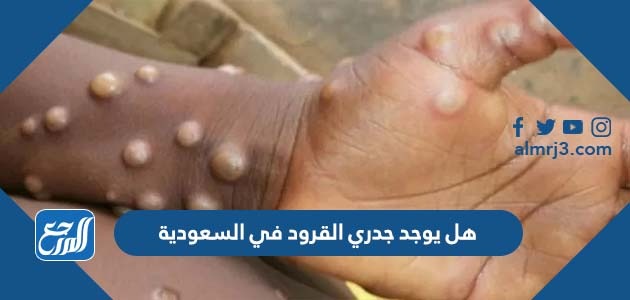 هل يوجد جدري القرود في السعودية