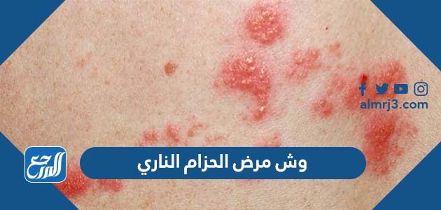 وش مرض الحزام الناري