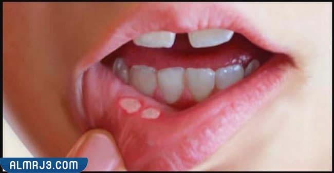 أسباب إصابة الطفل بتقرحات الفم
