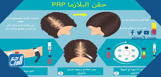 كم تكلفة حقن الشعر بالبلازما في السعودية؟