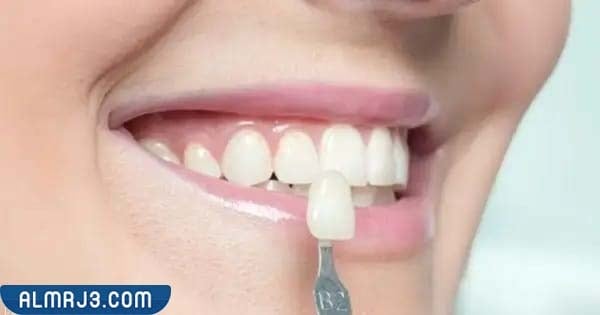 مميزات عدسات الاسنان