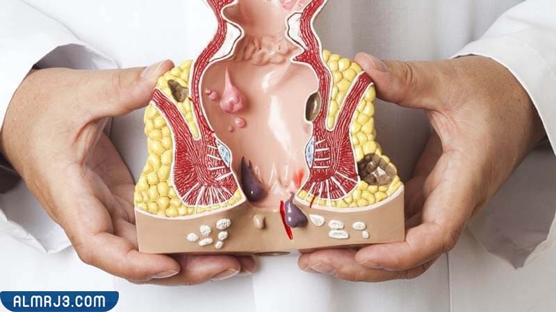 أسباب الإصابة بالبواسير 