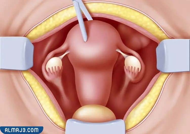 ما هو الوقت الذي تستغرقه عملية استئصال الرحم ومتى يتم الشفاء منها؟