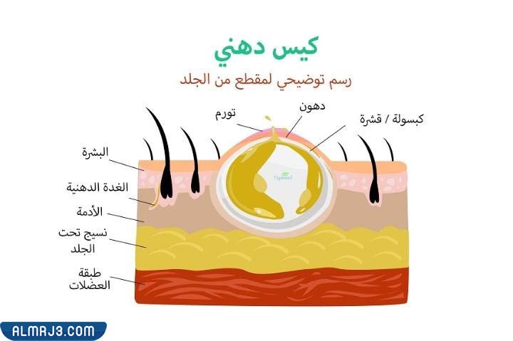 افضل مرهم لعلاج الكيس الدهني في العين