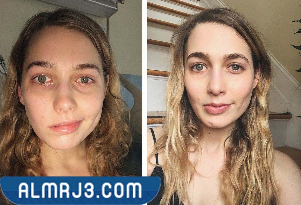 المضاعفات الناتجة عن متلازمة رامسي هانت