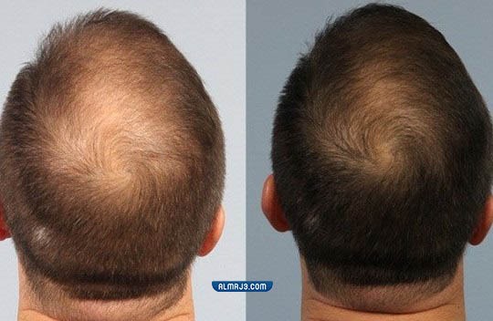 تجربتي مع حقن البلازما للشعر للرجال