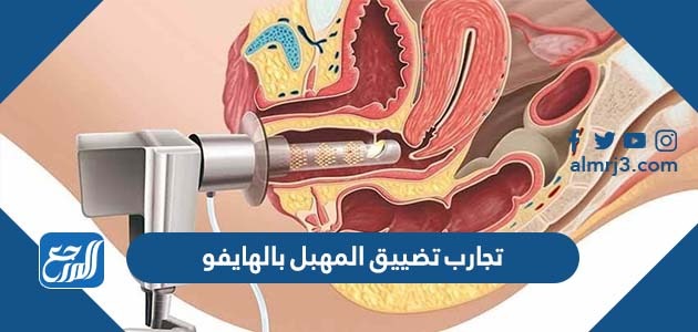تجارب تضييق المهبل بالهايفو