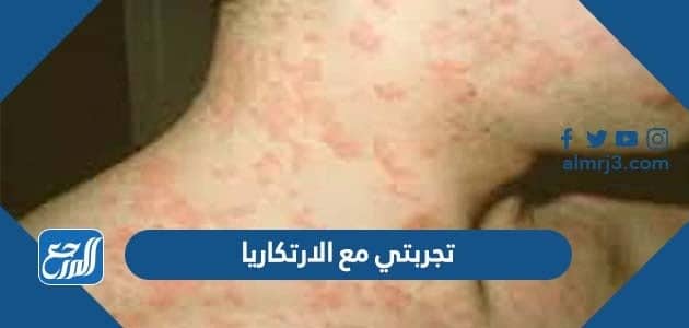 تجربتي مع الارتكاريا