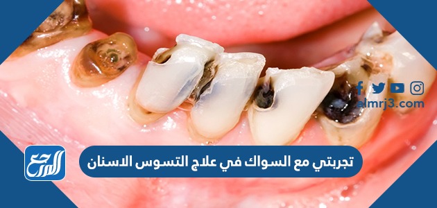 تجربتي مع السواك في علاج التسوس الاسنان