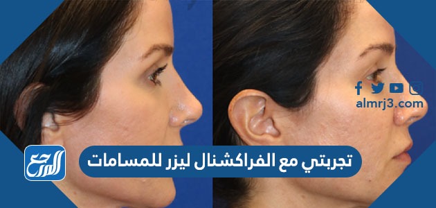 تجربتي مع الفراكشنال ليزر للمسامات