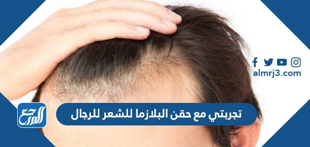 تجربتي مع حقن البلازما للشعر للرجال