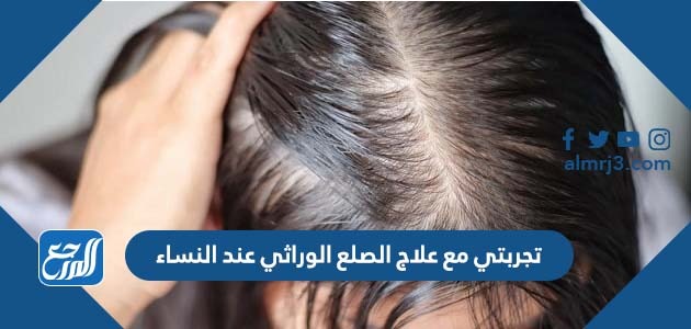 تجربتي مع علاج الصلع الوراثي عند النساء