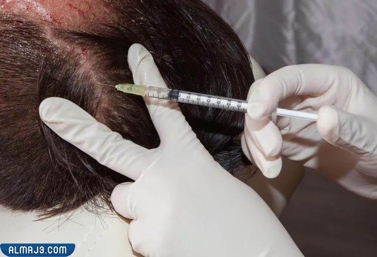 كيف تتم عملية حقن الشعر بالبلازما؟
