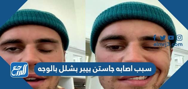 سبب اصابه جاستن بيبر بشلل بالوجه