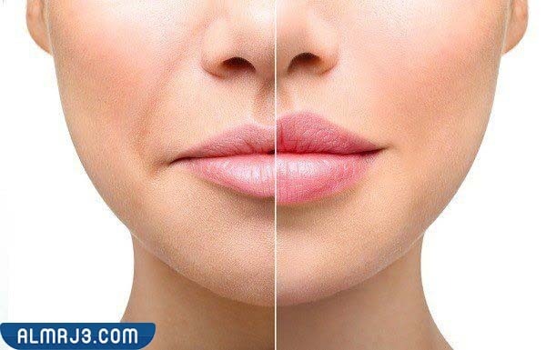 أنواع الفيلر