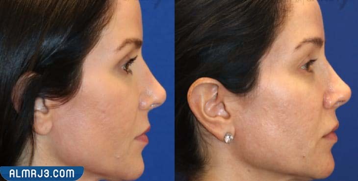 شكل الوجه بعد جلسة الفراكشنال ليزر