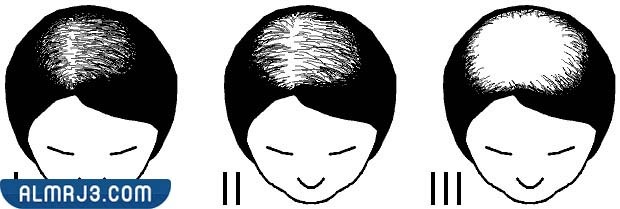 تجربتي مع علاج الصلع الوراثي عند النساء بالبلازما