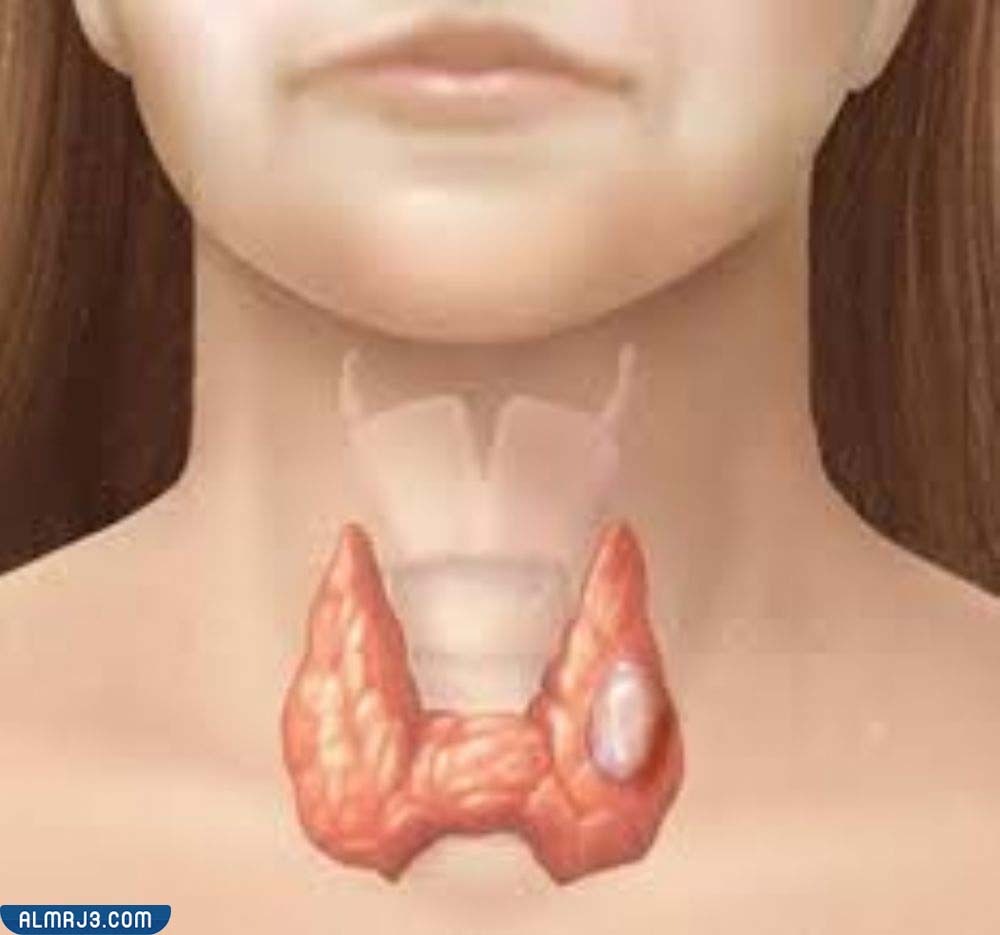 طرق علاج الغدة الدرقية