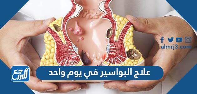 علاج البواسير في يوم واحد