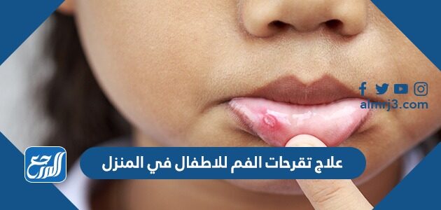علاج تقرحات الفم للاطفال في المنزل