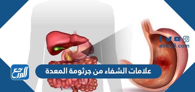 علامات الشفاء من جرثومة المعدة