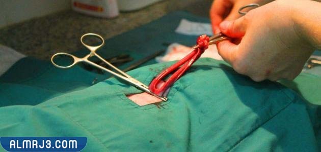 آثار ما بعد استئصال الرحم