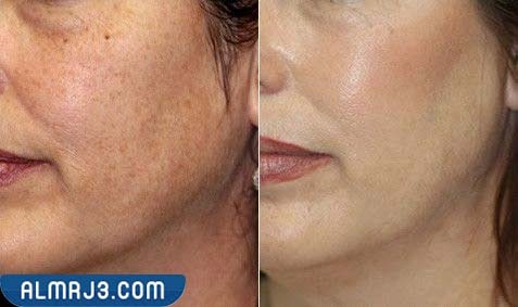 فوائد الفراكشنال ليزر للبشرة والتجاعيد