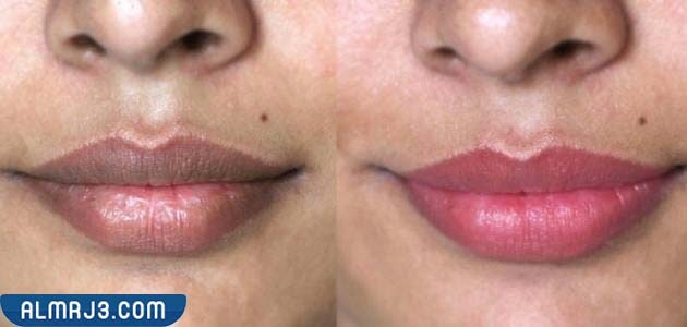 فوائد ليزر توريد الشفايف