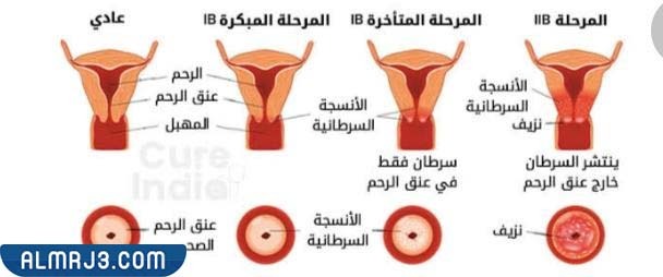 كيف أعرف أن الثالول التناسلي مات