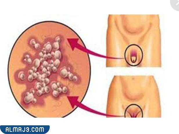 كيفية تشخيص ثآليل الأعضاء التناسلية