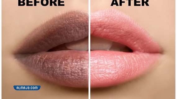 ما هي عملية توريد الشفايف بالليزر