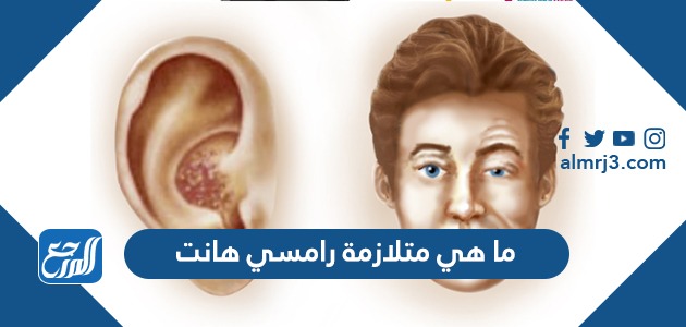 ما هي متلازمة رامسي هانت