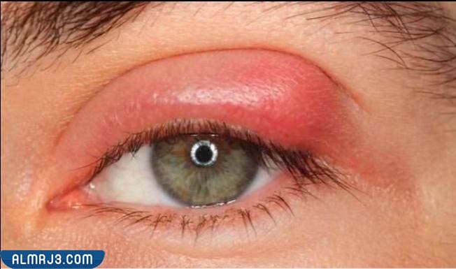 افضل مرهم لعلاج الكيس الدهني في العين