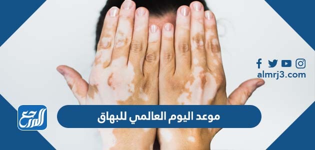 موعد اليوم العالمي للبهاق 