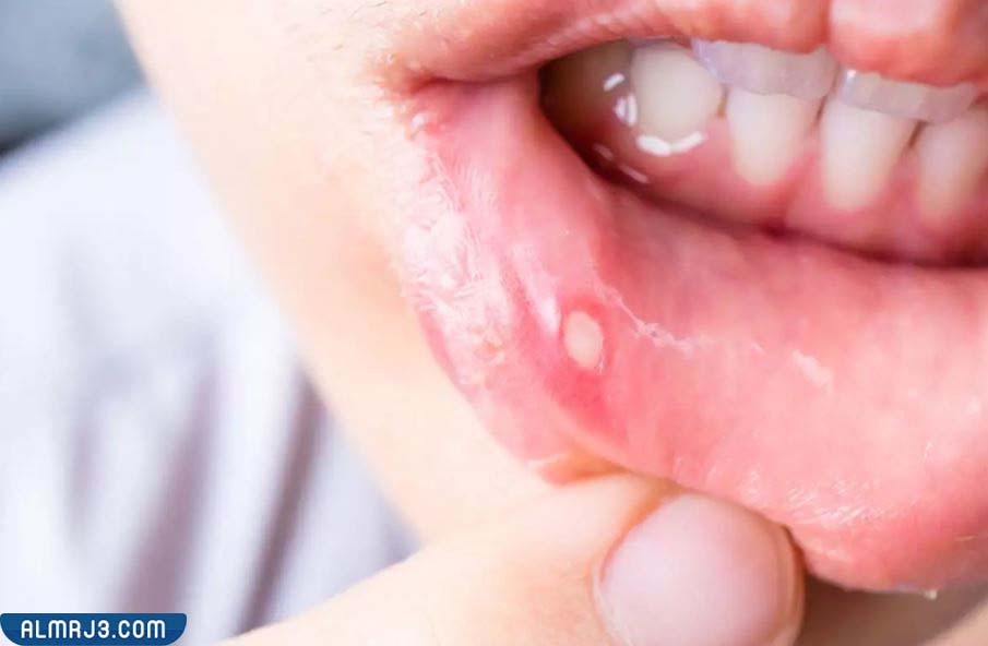 نصائح للوقاية من إصابة الطفل بتقرحات الفم