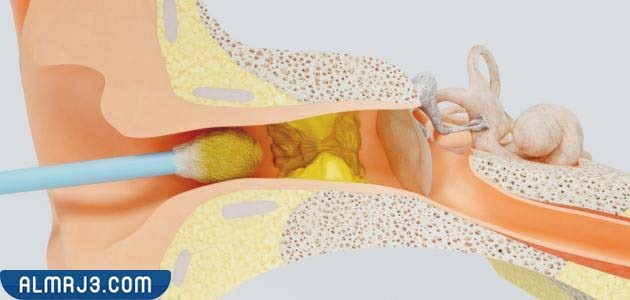 نصائح للوقاية من تراكم الشمع داخل الأذن