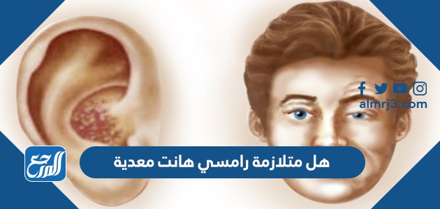 هل متلازمة رامسي هانت معدية