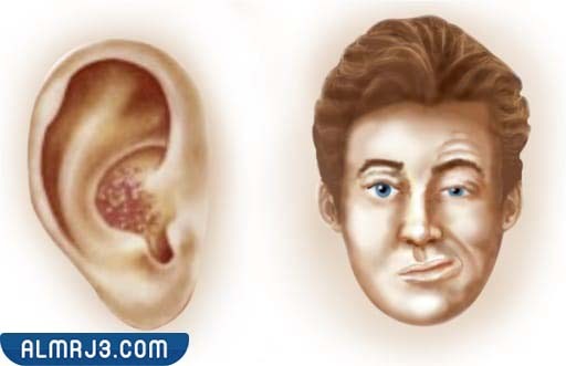 متلازمة رامسي هانت