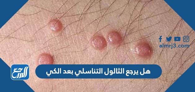 هل يرجع الثالول التناسلي بعد الكي