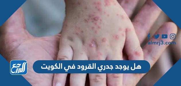 هل يوجد جدري القرود في الكويت