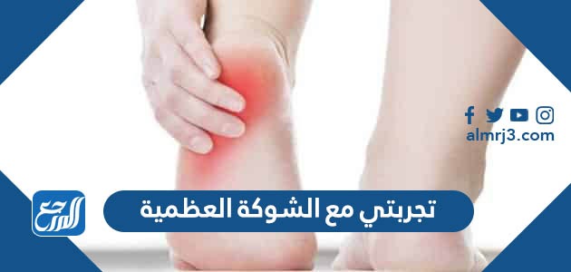 تجربتي مع الشوكة العظمية