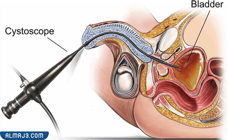 أسباب اللجوء إلى منظار المثانة