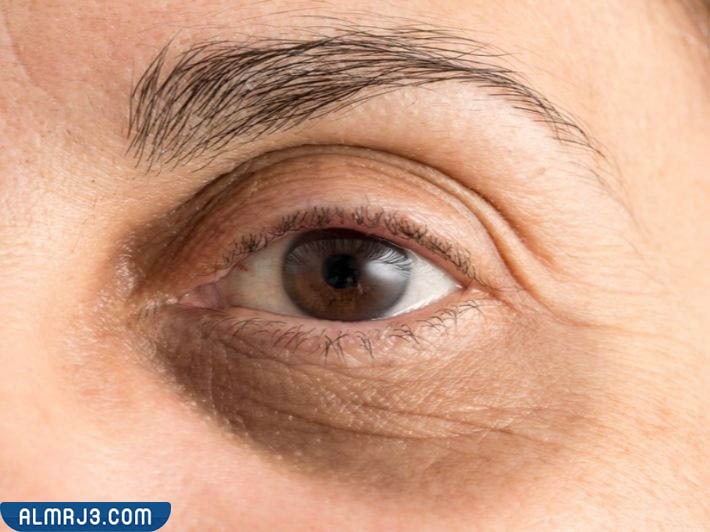 أسباب ظهور تكتلات الفيلر تحت العين