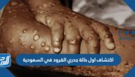 حقيقة اكتشاف اول حالة جدري القرود في السعودية