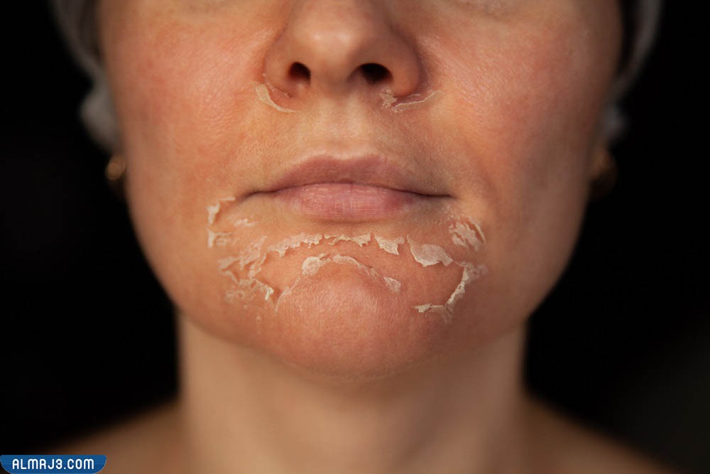 الآثار الجانبية الناتجة عن التقشير الكيميائي في المنزل 