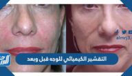 التقشير الكيميائي للوجه قبل وبعد