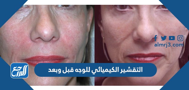 التقشير الكيميائي للوجه قبل وبعد