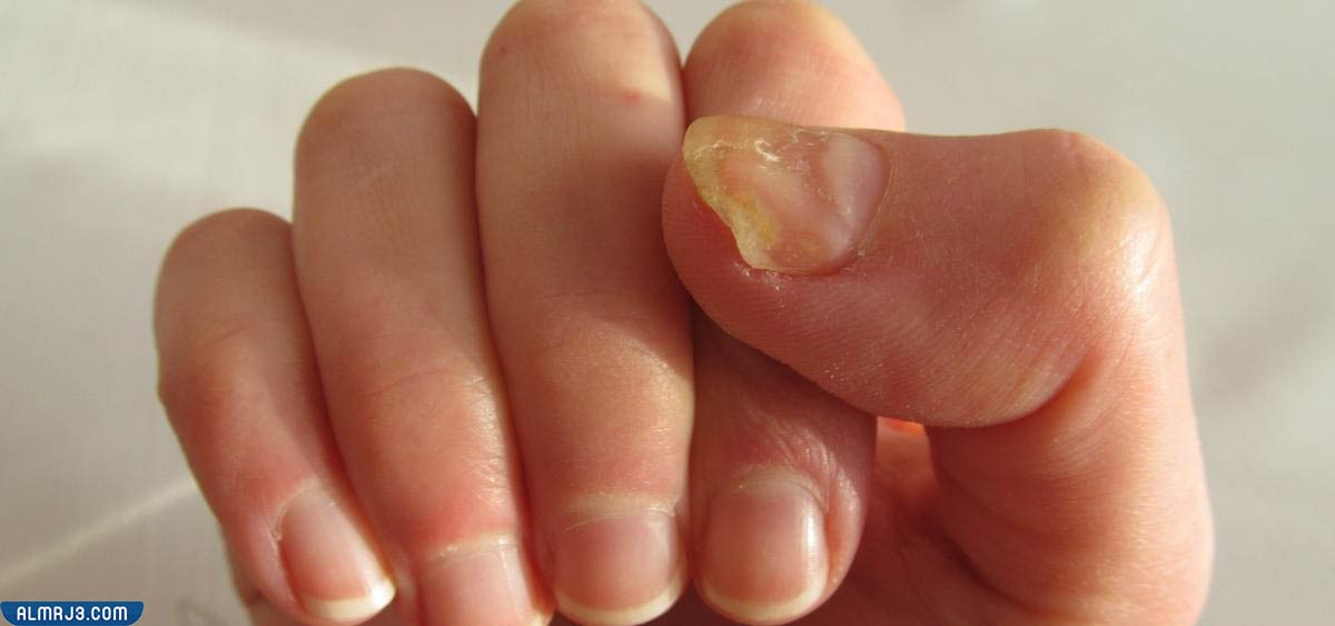 الحل النهائي للقضاء على فطريات الأظافر