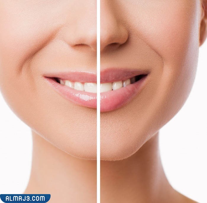 المضاعفات الناتجة عن تحديد الفك بالفيلر